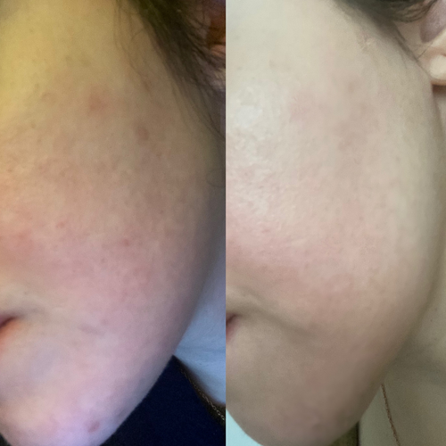 Before and After: Transformative Effects of Proper Skincare